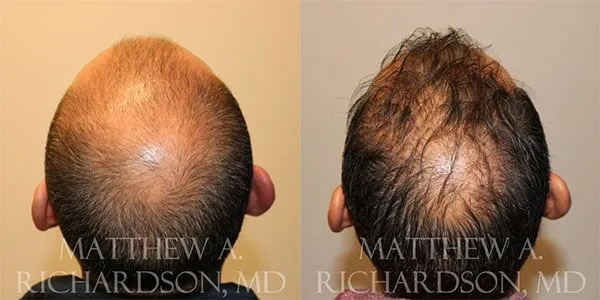 Hair Transplant Before and After photo by Texas Facial Aesthetics in Frisco, TX