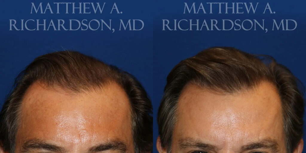 Hair Transplant Before and After photo by Texas Facial Aesthetics in Frisco, TX