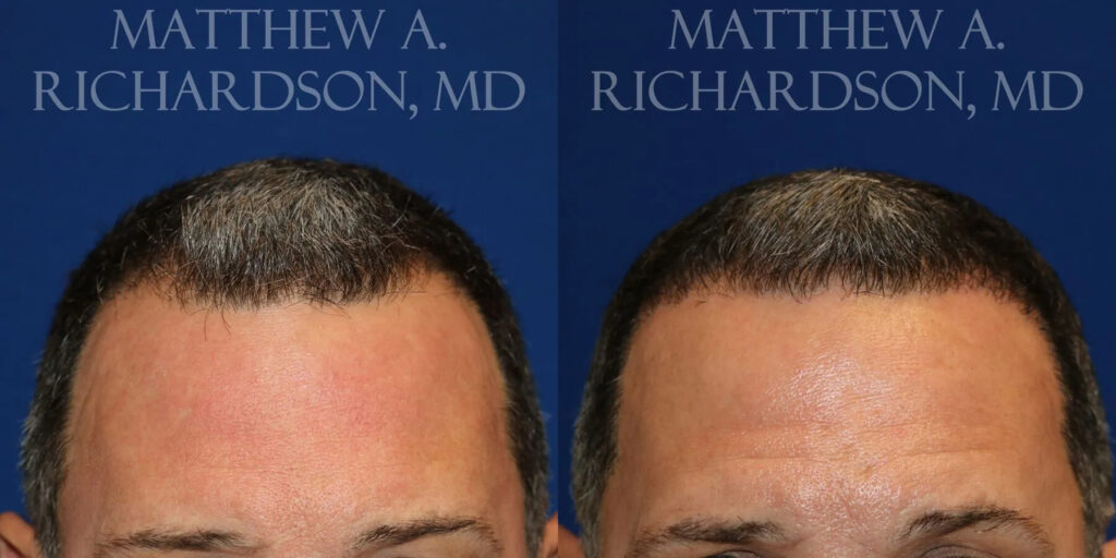 Hair Transplant Before and After photo by Texas Facial Aesthetics in Frisco, TX