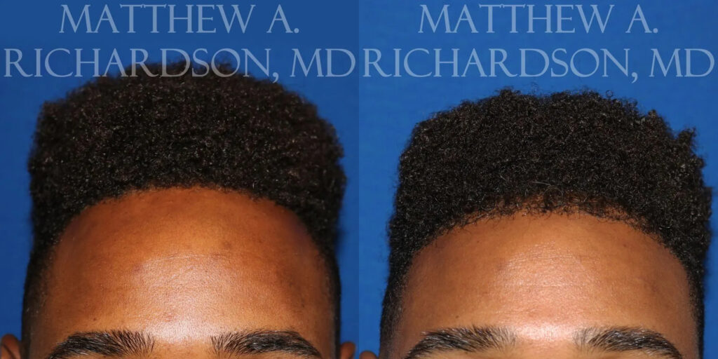 Hair Transplant Before and After photo by Texas Facial Aesthetics in Frisco, TX