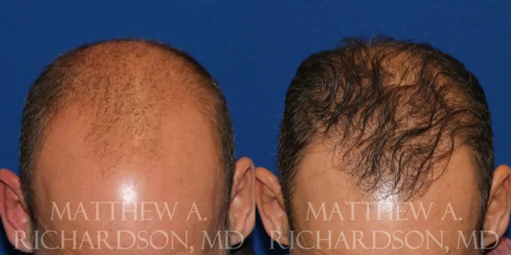 Hair Transplant Before and After photo by Texas Facial Aesthetics in Frisco, TX