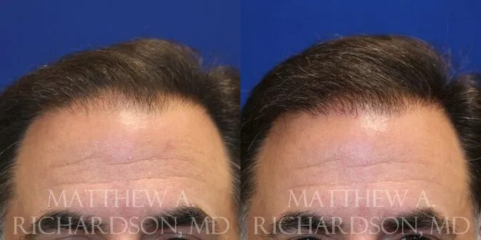 Hair Transplant Before and After photo by Texas Facial Aesthetics in Frisco, TX