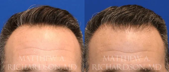 Hair Transplant Before and After photo by Texas Facial Aesthetics in Frisco, TX