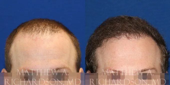 Hair Transplant Before and After photo by Texas Facial Aesthetics in Frisco, TX