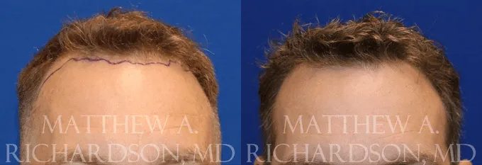 Hair Transplant Before and After photo by Texas Facial Aesthetics in Frisco, TX