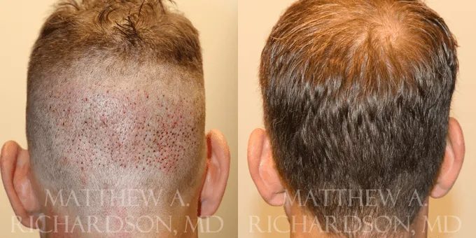 Hair Transplant Before and After photo by Texas Facial Aesthetics in Frisco, TX