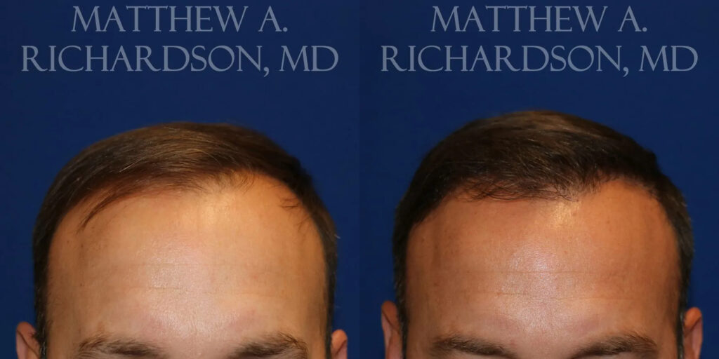 Hair Transplant Before and After photo by Texas Facial Aesthetics in Frisco, TX