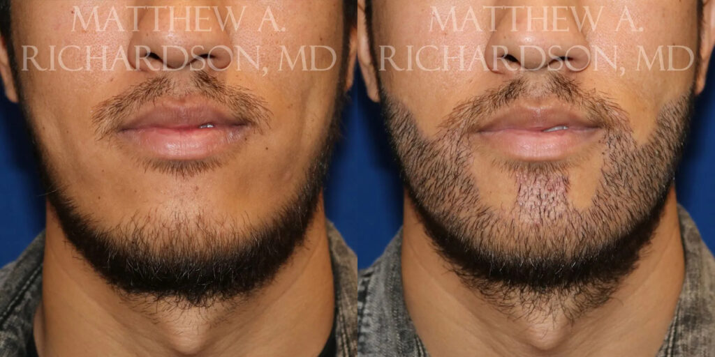 Hair Transplant Before and After photo by Texas Facial Aesthetics in Frisco, TX