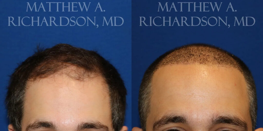 Hair Transplant Before and After photo by Texas Facial Aesthetics in Frisco, TX