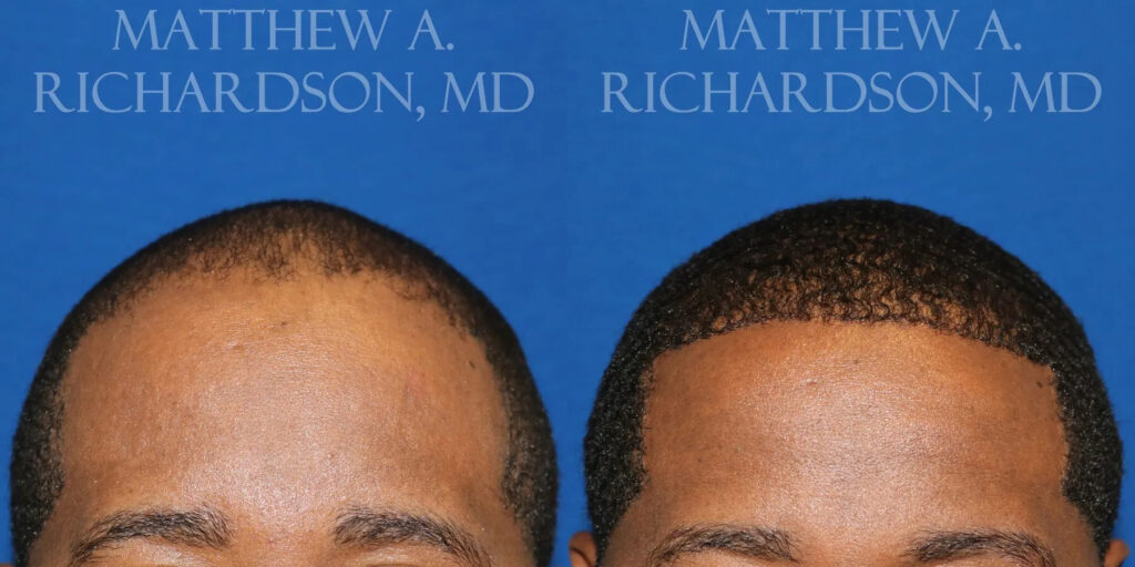 Hair Transplant Before and After photo by Texas Facial Aesthetics in Frisco, TX