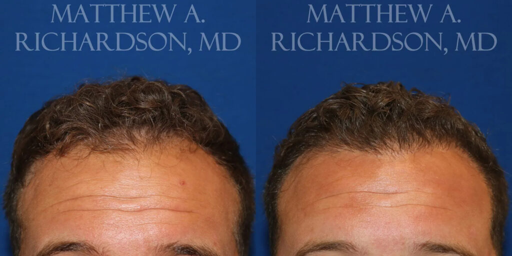 Hair Transplant Before and After photo by Texas Facial Aesthetics in Frisco, TX