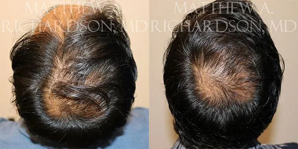 Hair Transplant Before and After photo by Texas Facial Aesthetics in Frisco, TX