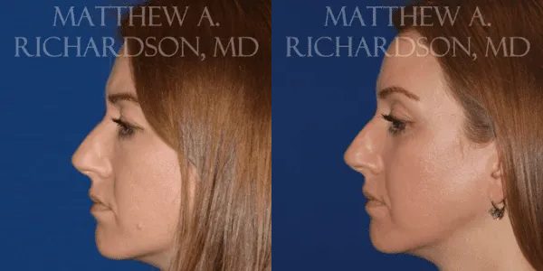 Laser Skin Resurfacing Before and After photo by Texas Facial Aesthetics in Frisco, TX Laser Skin Resurfacing Before and After photo by Texas Facial Aesthetics in Frisco, TX