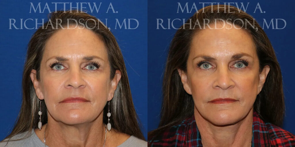 Laser Skin Resurfacing Before and After photo by Texas Facial Aesthetics in Frisco, TX