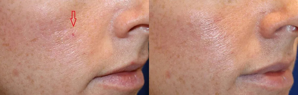 Laser Vein Removal Before and After photo by Texas Facial Aesthetics in Frisco, TX