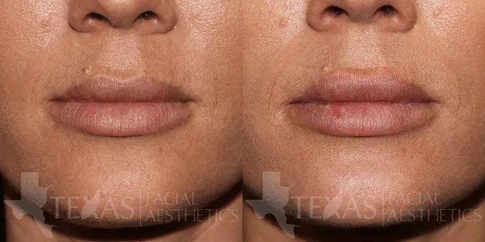 Lip Augmentation Before and After photo by Texas Facial Aesthetics in Frisco, TX