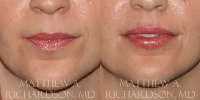 Lip Augmentation Before and After photo by Texas Facial Aesthetics in Frisco, TX