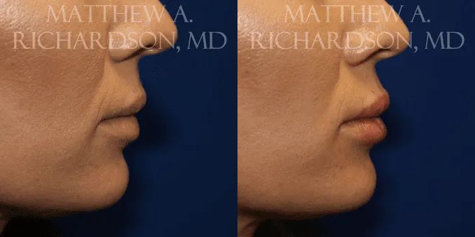 Lip Augmentation Before and After photo by Texas Facial Aesthetics in Frisco, TX