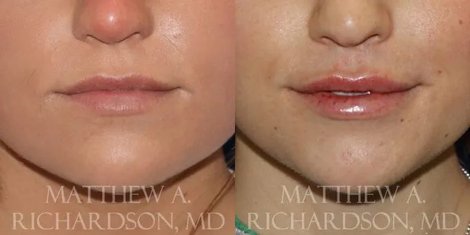 Lip Augmentation Before and After photo by Texas Facial Aesthetics in Frisco, TX