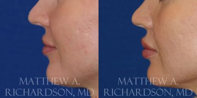 Lip Augmentation Before and After photo by Texas Facial Aesthetics in Frisco, TX