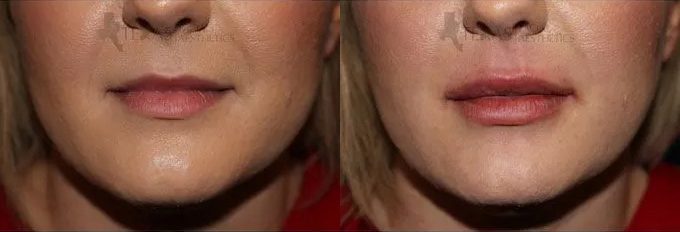 Lip Augmentation Before and After photo by Texas Facial Aesthetics in Frisco, TX