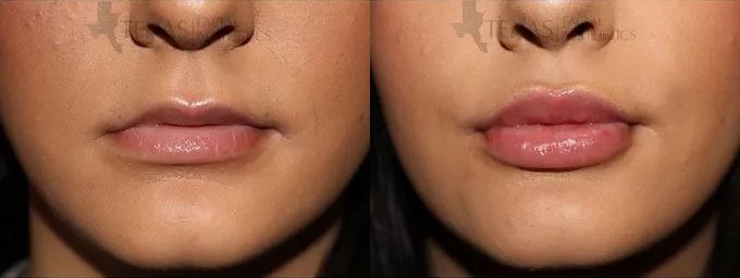 Lip Augmentation Before and After photo by Texas Facial Aesthetics in Frisco, TX