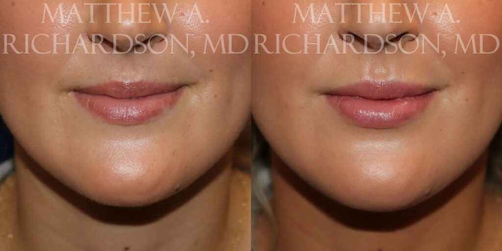 Lip Augmentation Before and After photo by Texas Facial Aesthetics in Frisco, TX