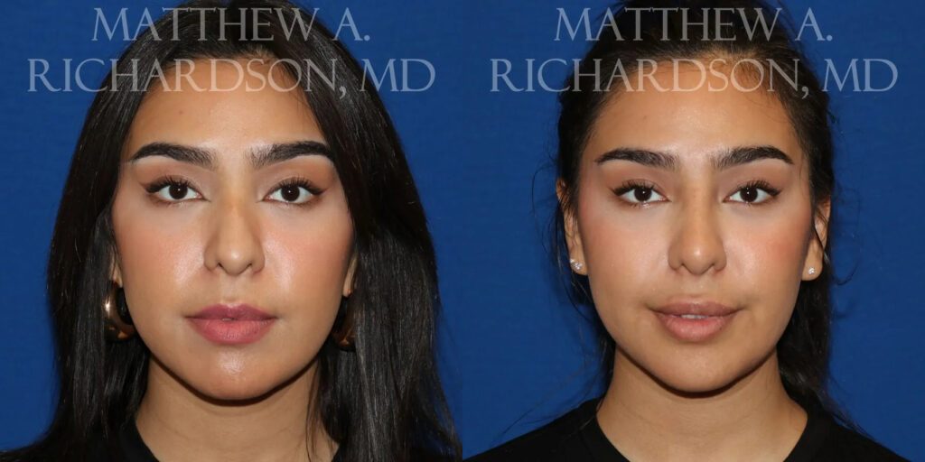 Lip Augmentation Before and After photo by Texas Facial Aesthetics in Frisco, TX