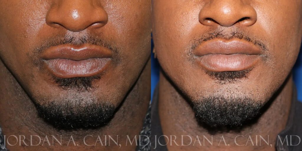 Lip Augmentation Before and After photo by Texas Facial Aesthetics in Frisco, TX