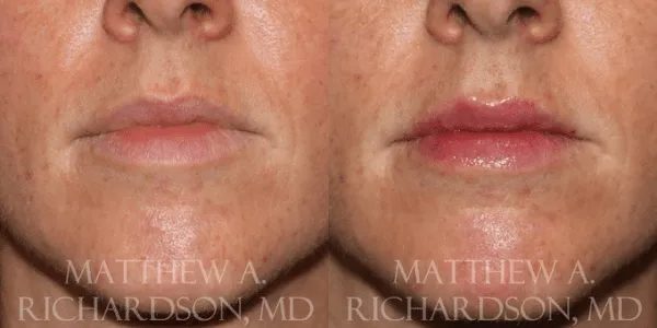 Lip Augmentation Before and After photo by Texas Facial Aesthetics in Frisco, TX