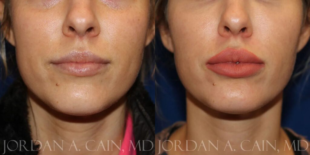 Lip Augmentation Before and After photo by Texas Facial Aesthetics in Frisco, TX