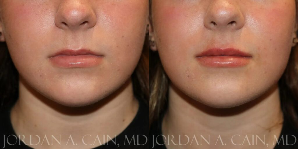 Lip Augmentation Before and After photo by Texas Facial Aesthetics in Frisco, TX