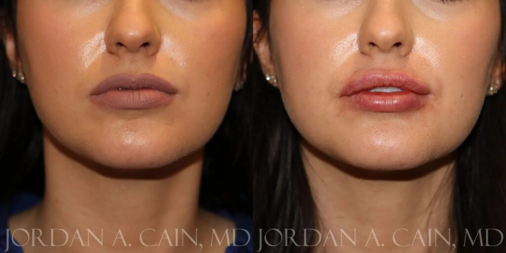 Lip Augmentation Before and After photo by Texas Facial Aesthetics in Frisco, TX