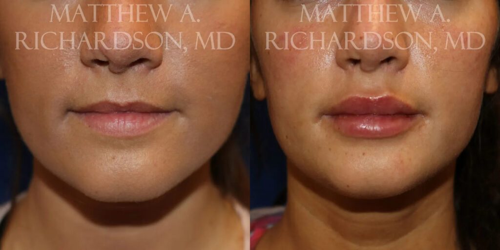 Lip Augmentation Before and After photo by Texas Facial Aesthetics in Frisco, TX