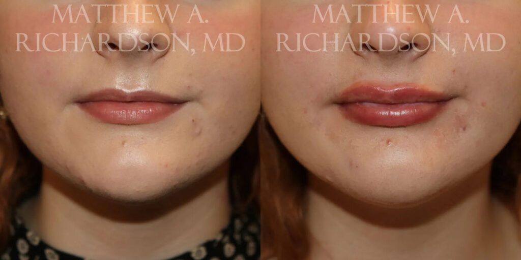 Lip Augmentation Before and After photo by Texas Facial Aesthetics in Frisco, TX