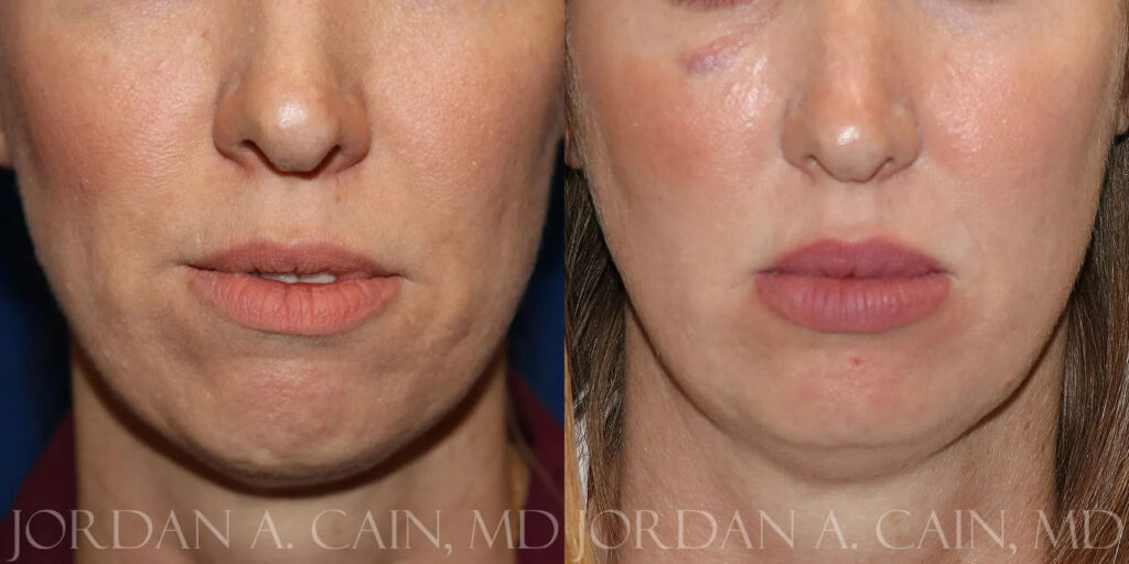 Lip Augmentation Before and After photo by Texas Facial Aesthetics in Frisco, TX