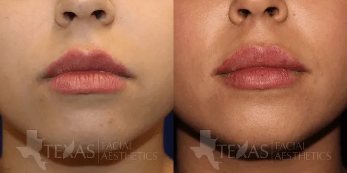 Lip Augmentation Before and After photo by Texas Facial Aesthetics in Frisco, TX