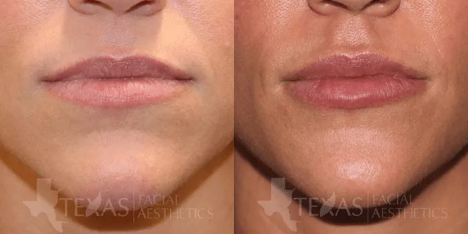 Lip Augmentation Before and After photo by Texas Facial Aesthetics in Frisco, TX