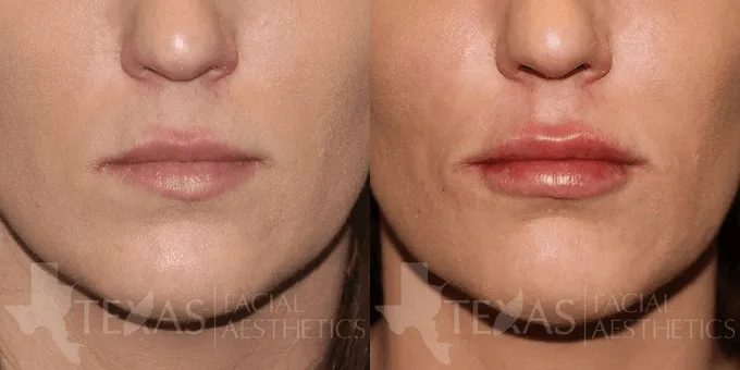 Lip Augmentation Before and After photo by Texas Facial Aesthetics in Frisco, TX