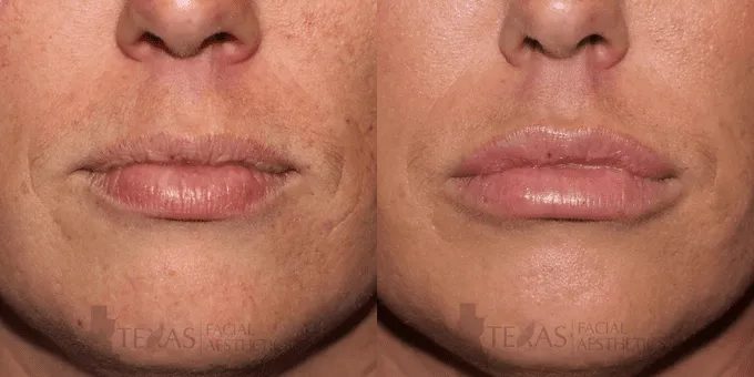 Lip Augmentation Before and After photo by Texas Facial Aesthetics in Frisco, TX