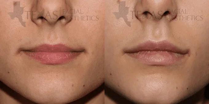 Lip Augmentation Before and After photo by Texas Facial Aesthetics in Frisco, TX