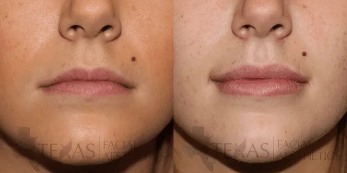 Lip Augmentation Before and After photo by Texas Facial Aesthetics in Frisco, TX