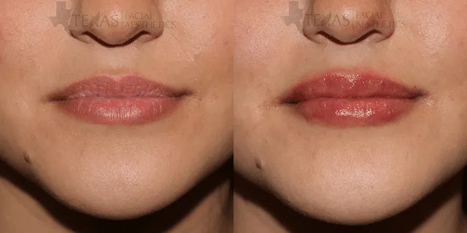 Lip Augmentation Before and After photo by Texas Facial Aesthetics in Frisco, TX