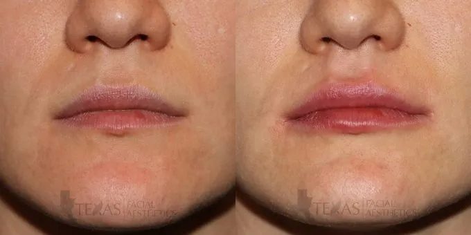 Lip Augmentation Before and After photo by Texas Facial Aesthetics in Frisco, TX