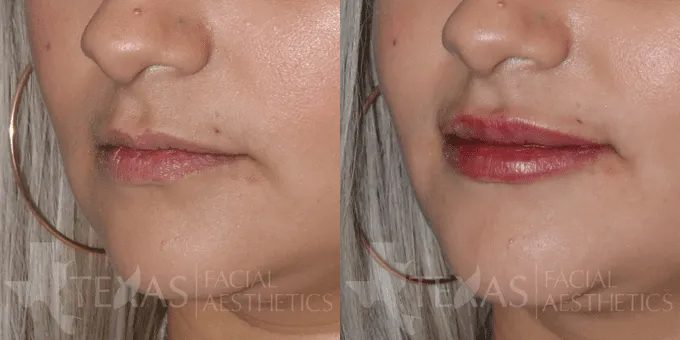 Lip Augmentation Before and After photo by Texas Facial Aesthetics in Frisco, TX