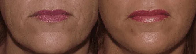 Lip Augmentation Before and After photo by Texas Facial Aesthetics in Frisco, TX