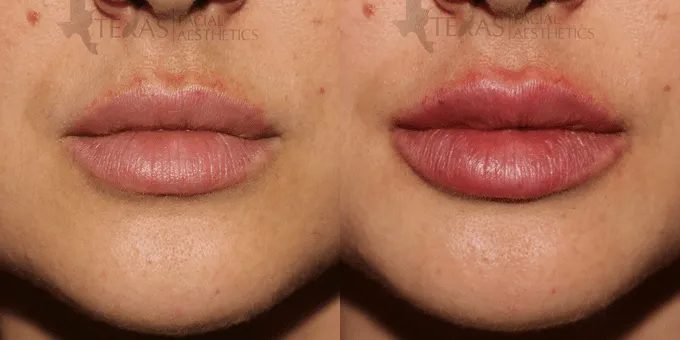 Lip Augmentation Before and After photo by Texas Facial Aesthetics in Frisco, TX