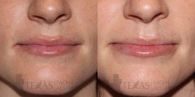 Lip Augmentation Before and After photo by Texas Facial Aesthetics in Frisco, TX