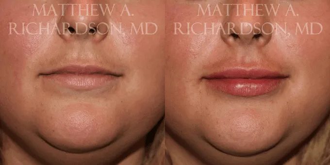 Lip Augmentation Before and After photo by Texas Facial Aesthetics in Frisco, TX