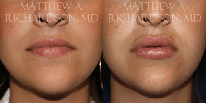 Lip Augmentation Before and After photo by Texas Facial Aesthetics in Frisco, TX